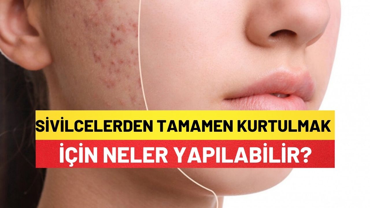 Sivilcelerden Tamamen Kurtulmak İçin Neler Yapılabilir?