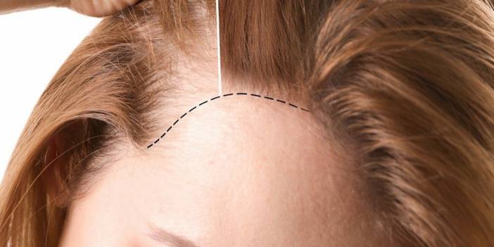 Kadınlarda Saç Ekimi Nasıl Olur?