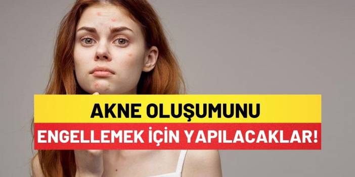Akne Oluşumunu Engellemek İçin Yapılacaklar!