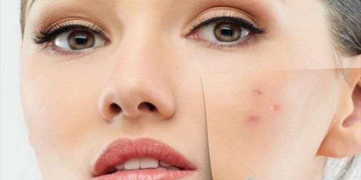 Akneli Ciltler İçin 3 Kamuflaj İpucu